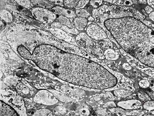 F,8y. | fibrillary astrocytoma